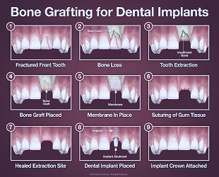 Bone Grafting - Dentist Chelmsford, MA - Dental Education Library